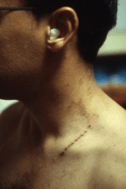 Image d'illustration pour Keraunopathologie : impact de la foudre sur le corps humain